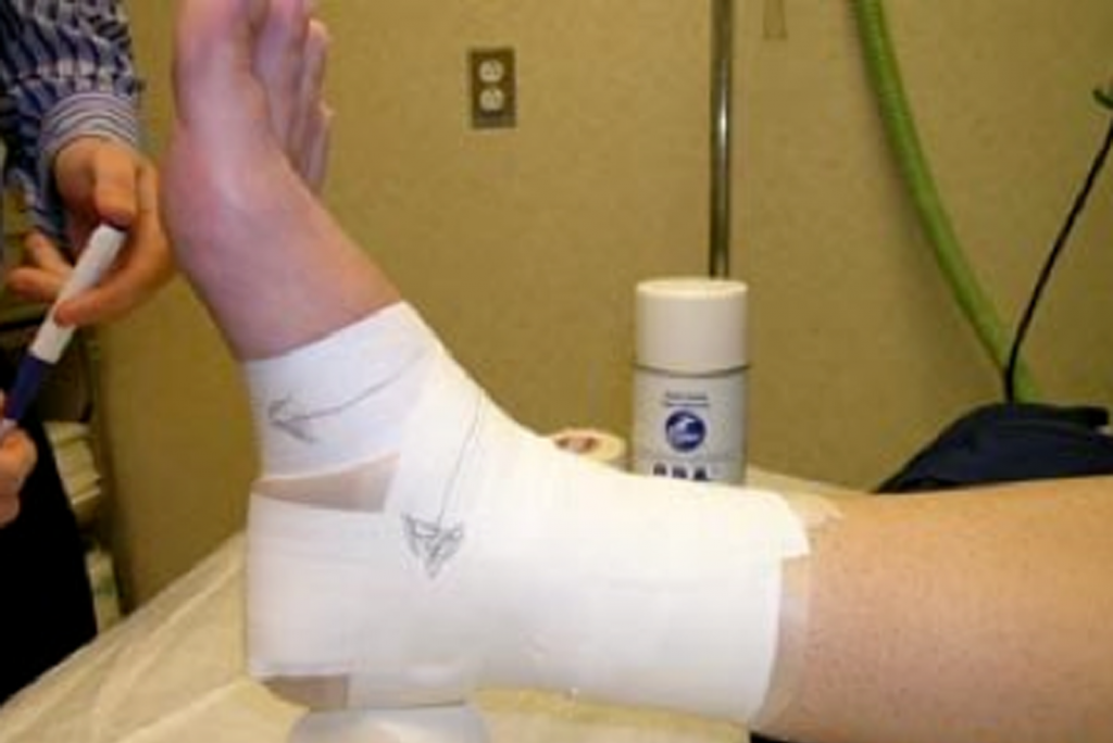 Tape for sports injuries Action Harpenden Physiotherapy